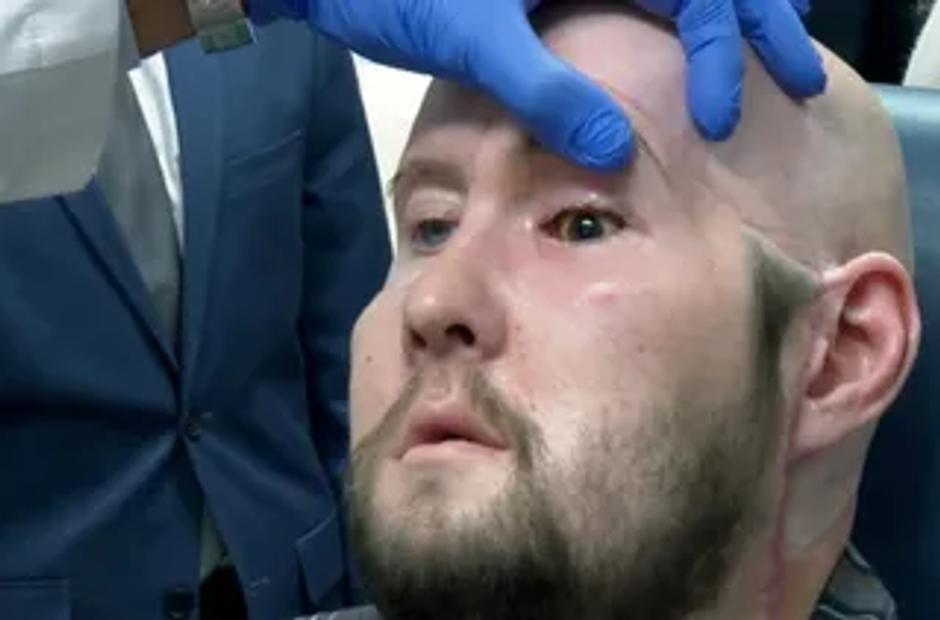 Primer transplante de ojo se realiza con éxito en Nueva York